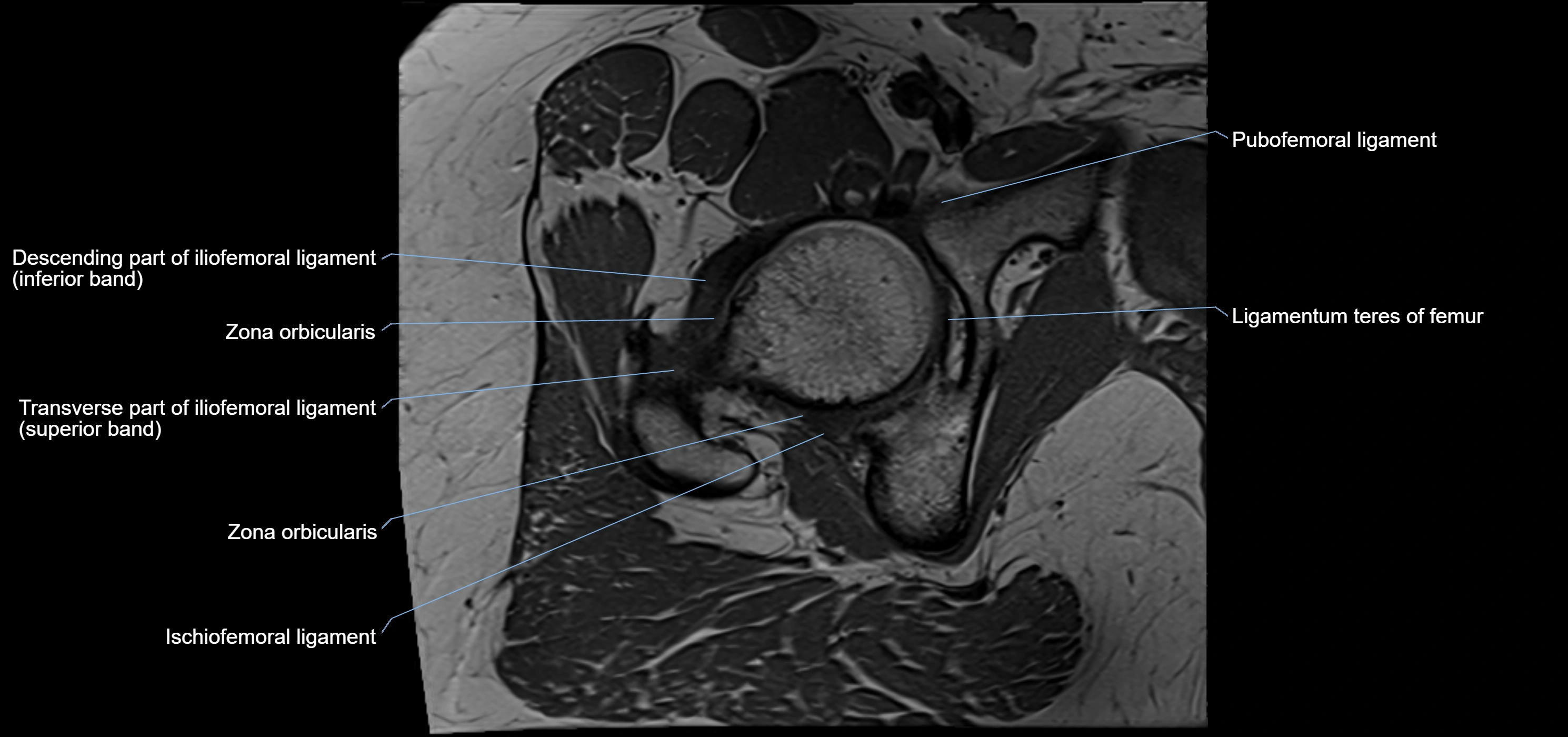 Hip ligament anatomy axial 3T MRI image -img-13001-00018.webp